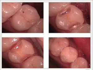 fillings