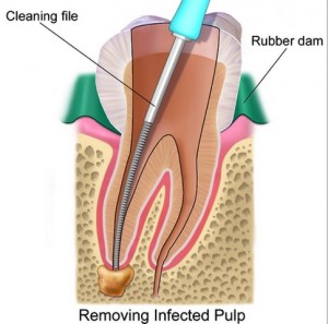root_canal